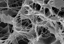 Lidocaina inefficace nella Sclerodermia